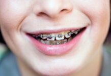 Do You Need Braces Your Jaw is Misaligned?