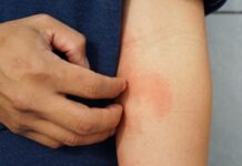 Eczema Hacks: 10 Fast and Effective Relief Strategies – 2024 Guide Eczema