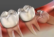 The Hidden Truth About Wisdom Teeth: Removal and Recovery Tips (2023) Wisdom Teeth