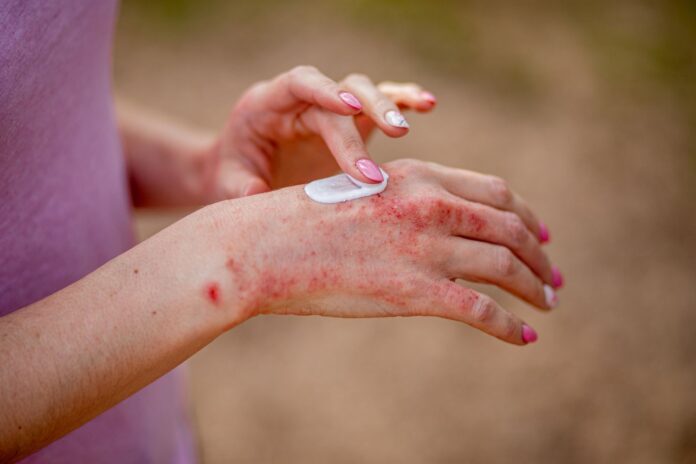 Dealing with Eczema
