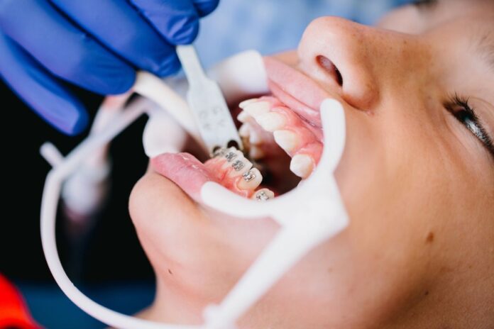 Science Behind Orthodontics Biomechanics